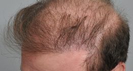 Combined Technique of FUT+FUE Hair Transplant: When & How