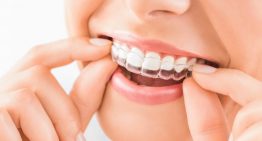 How Does Invisalign Work? Here’s What You Need To Know