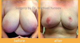 Breast Reduction Surgery, Why It’s Done