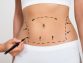 All You Need To Know About Liposculpture