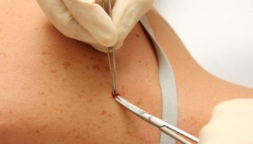 Skin Cancer Removal And What You Should Know