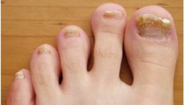 Fungal Nail Infection And What Can Sports Podiatrist Do For You