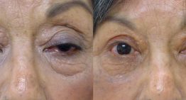 What is Superior Blepharoplasty