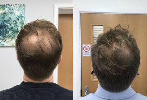 What a New Hair-Loss Pattern Can Tell You Before an Appointment